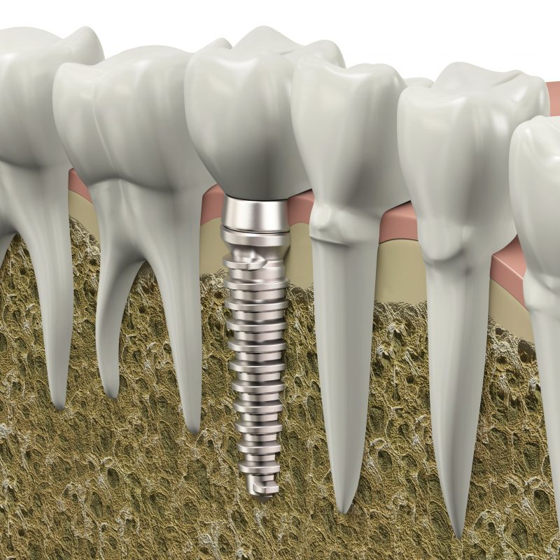 Dental Implants: What You Should Know