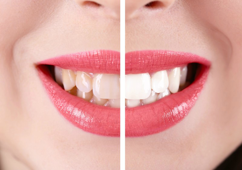 Boost Your Confidence with Teeth Whitening in Philadelphia